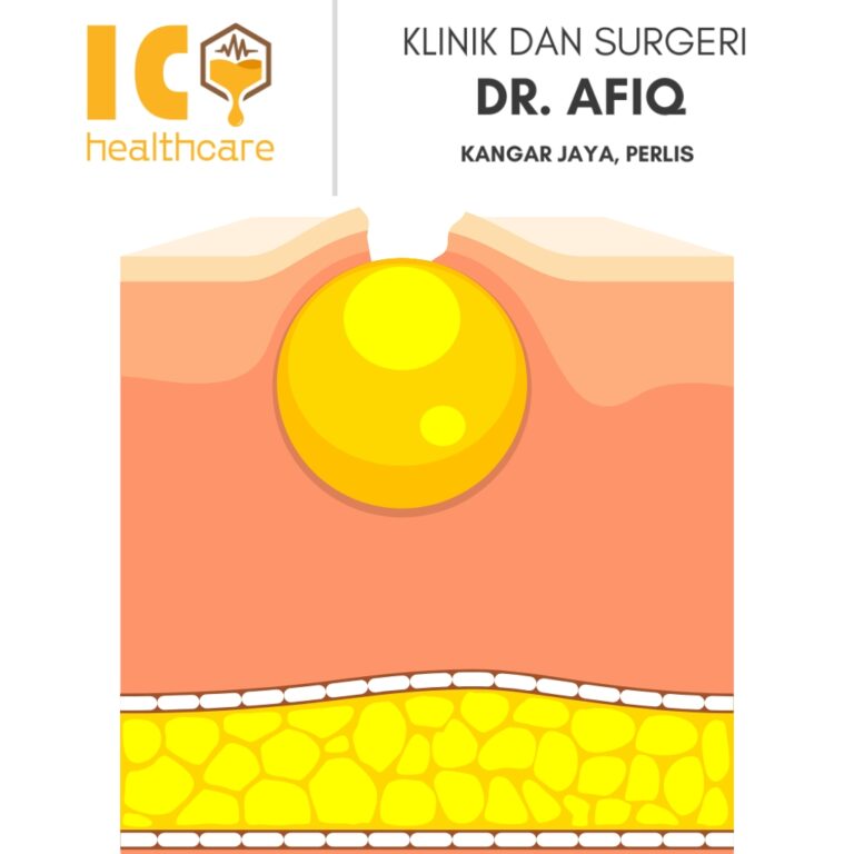 Buang Cyst di Kangar, Perlis | Klinik dan Surgeri Dr Afiq