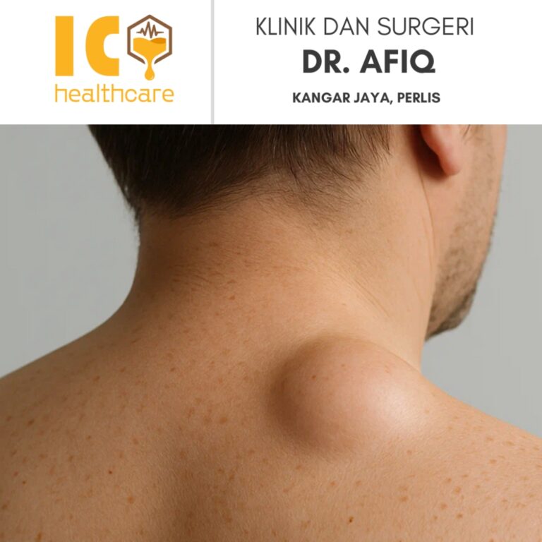Buang Lipoma di Kangar, Perlis | Klinik dan Surgeri Dr Afiq