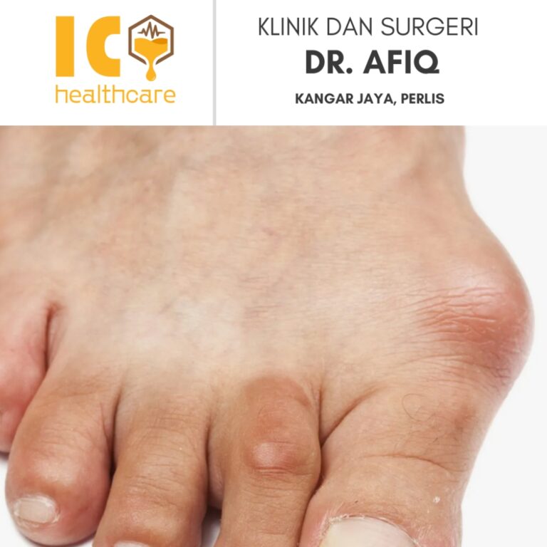 Buang Gout Tophi di Kangar, Perlis | Klinik dan Surgeri Dr Afiq
