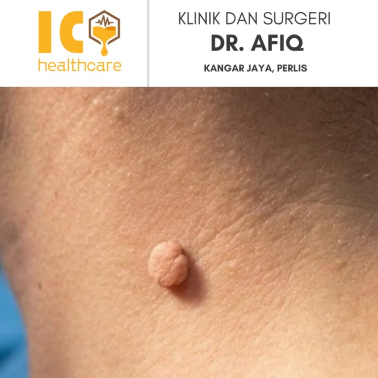 Buang Skin Tag di Kangar, Perlis | Klinik dan Surgeri Dr Afiq