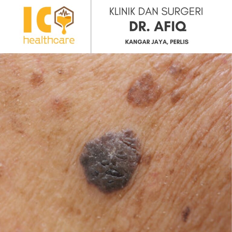 Buang Tahi Lalat di Kangar, Perlis | Klinik dan Surgeri Dr Afiq