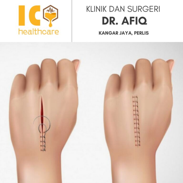 Jahit Luka di Kangar, Perlis | Klinik dan Surgeri Dr Afiq