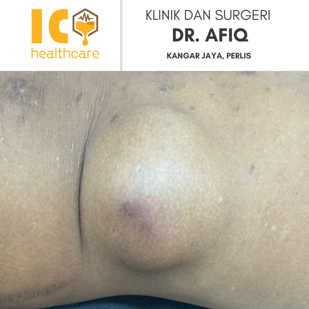 Gambar pesakit sebelum menjalani prosedur pembedahan minor buang ketulan di Klinik & Surgeri Dr. Afiq, Kangar, Perlis, menunjukkan ketulan atau cyst pada bahagian badan yang akan dirawat.