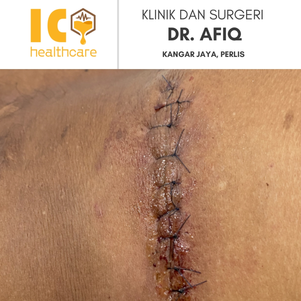 Gambar kawasan rawatan pesakit selepas berjaya menjalani prosedur buang ketulan di Klinik & Surgeri Dr. Afiq, Kangar, Perlis, menunjukkan jahitan kemas dan pemulihan yang baik selepas pembedahan minor.