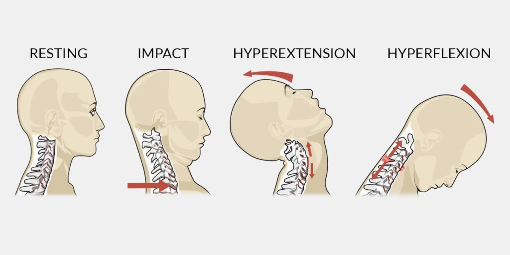 bagaimana whiplash berlaku di perlis