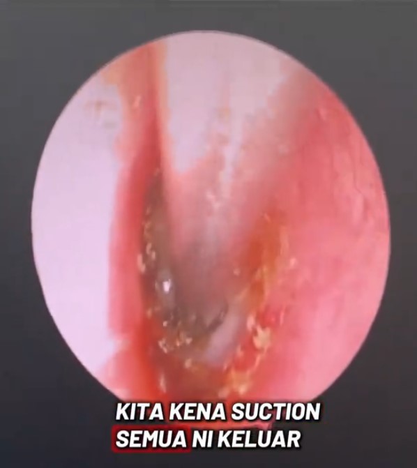 cuci telinga kangar